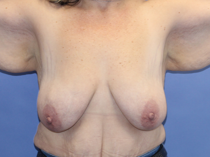 Breast Lift Before and After | PERK Plastic Surgery