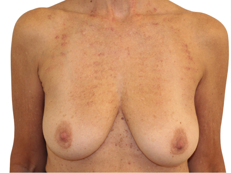 Breast Lift Before and After | PERK Plastic Surgery