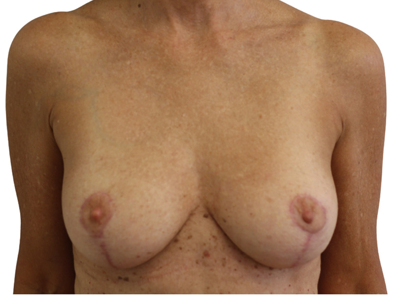 Breast Lift Before and After | PERK Plastic Surgery