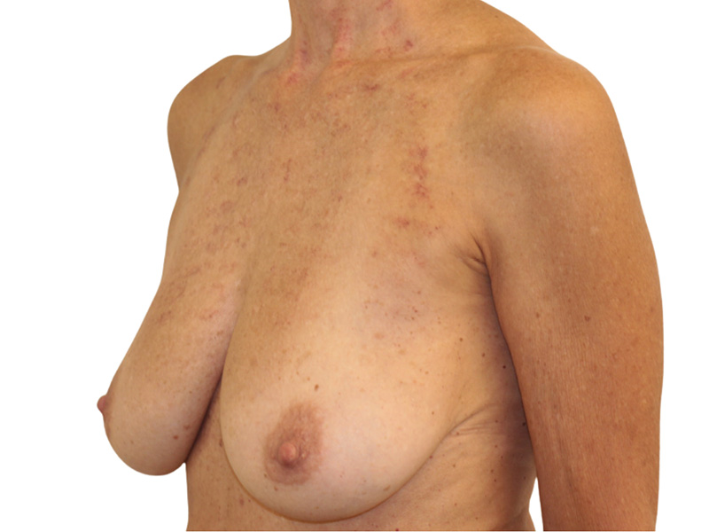 Breast Lift Before and After | PERK Plastic Surgery