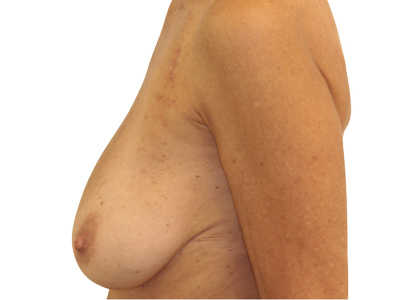 Breast Lift Before and After | PERK Plastic Surgery