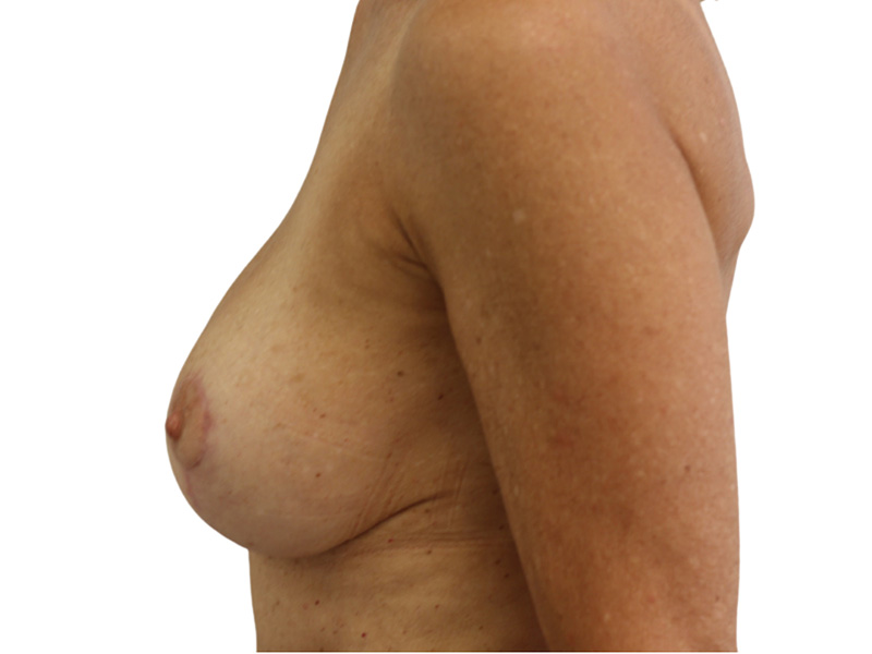 Breast Lift Before and After | PERK Plastic Surgery