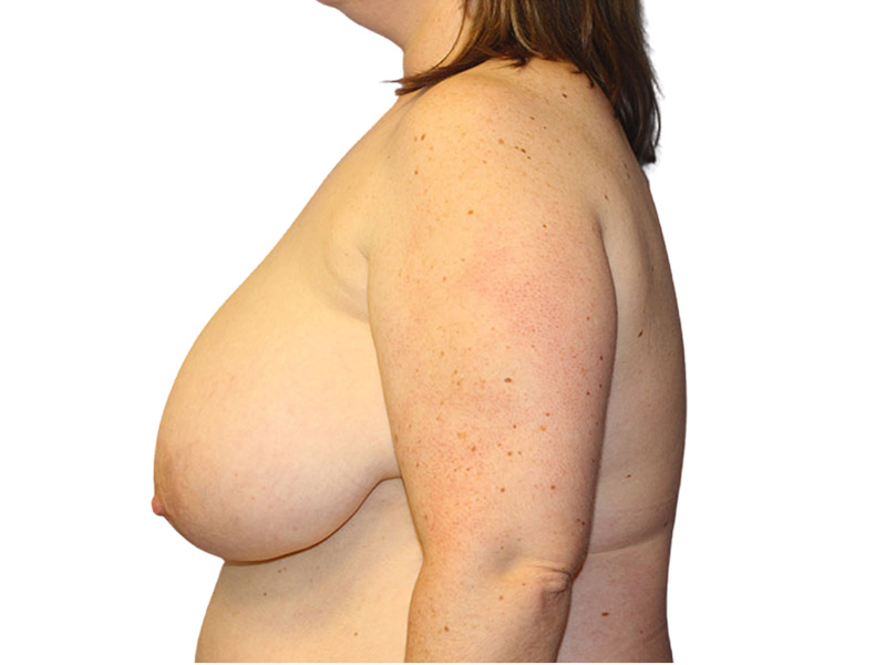 Breast Lift Before and After | PERK Plastic Surgery