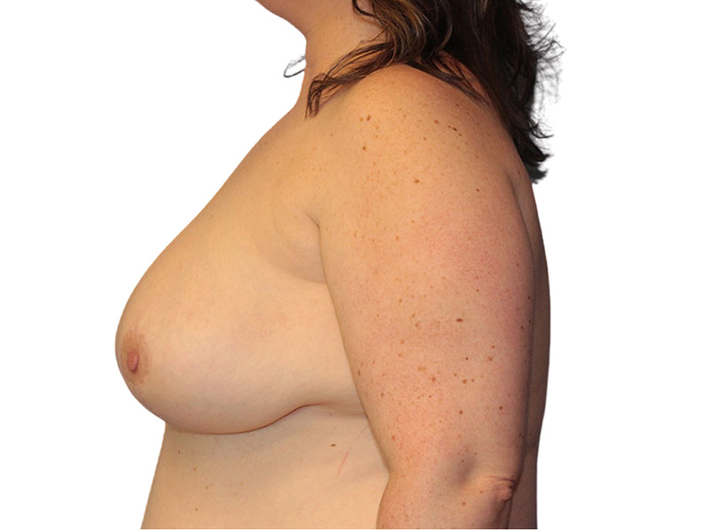 Breast Lift Before and After | PERK Plastic Surgery