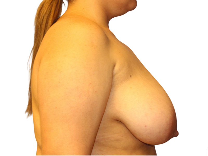 Breast Lift Before and After | PERK Plastic Surgery