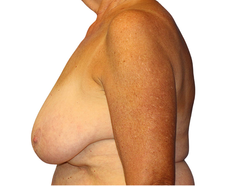 Breast Lift Before and After | PERK Plastic Surgery