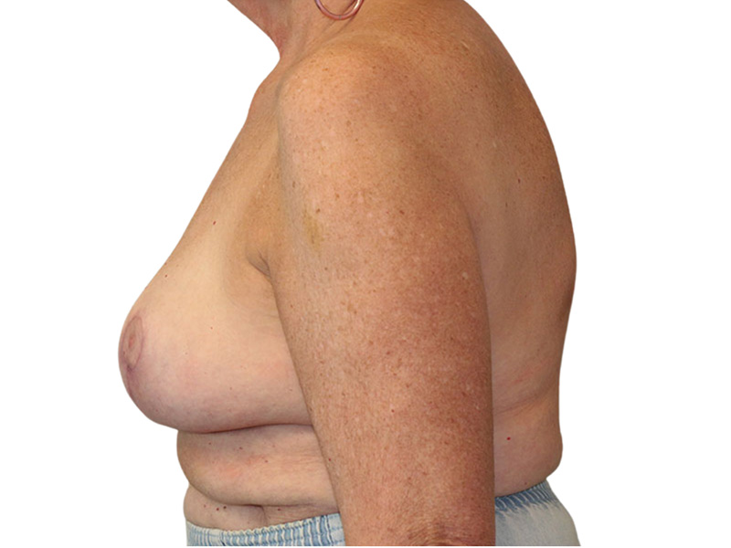 Breast Lift Before and After | PERK Plastic Surgery