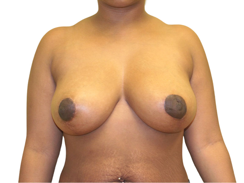 Breast Lift Before and After | PERK Plastic Surgery