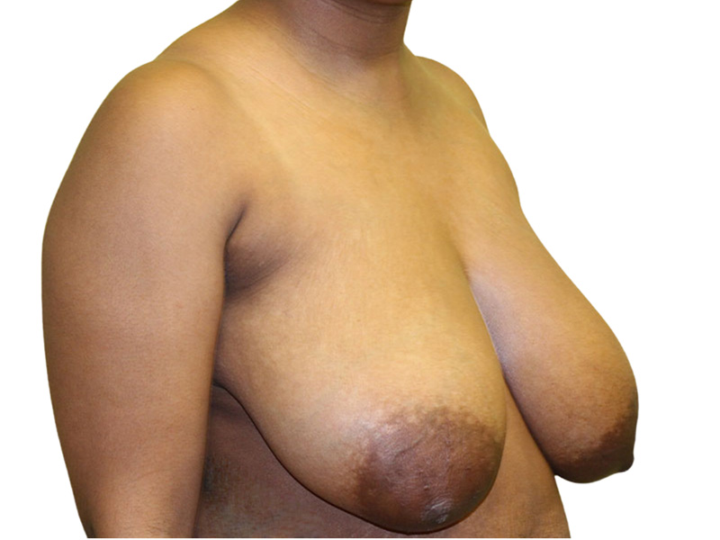 Breast Lift Before and After | PERK Plastic Surgery