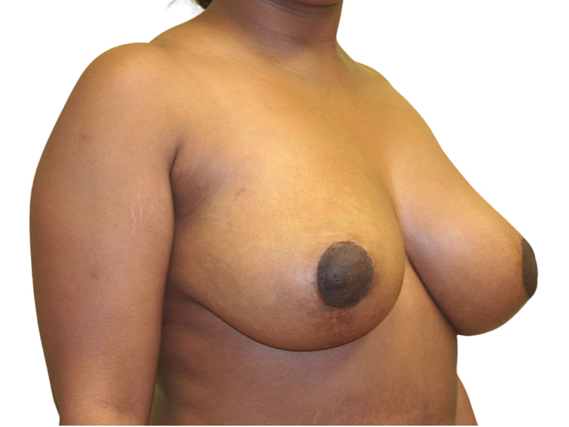 Breast Lift Before and After | PERK Plastic Surgery