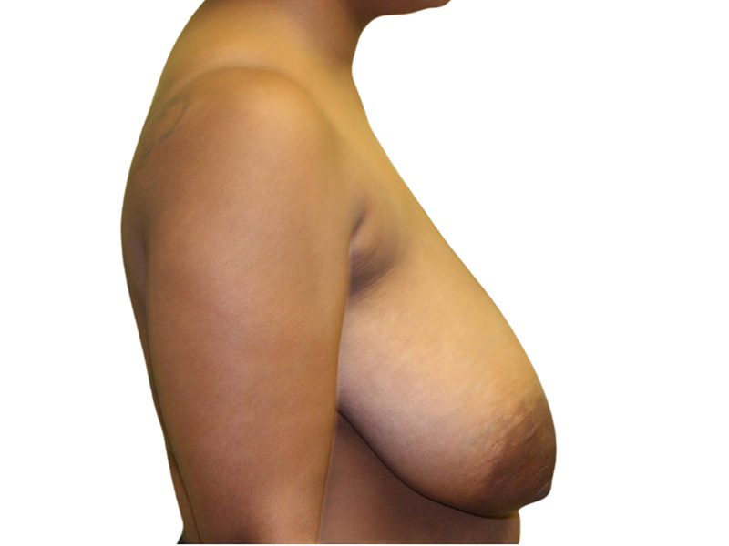 Breast Lift Before and After | PERK Plastic Surgery