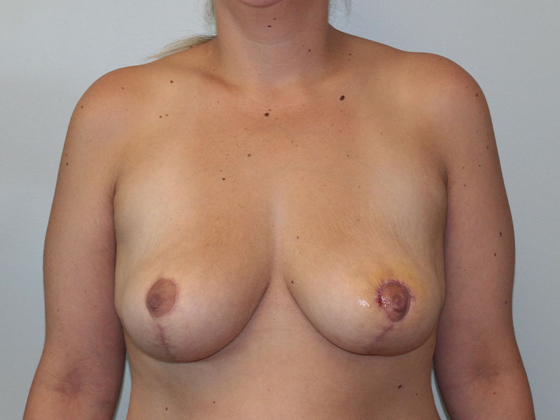Breast Lift Before and After | PERK Plastic Surgery