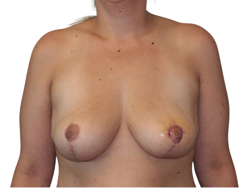 Breast Lift Before and After | PERK Plastic Surgery