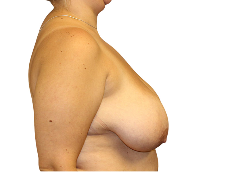 Breast Lift Before and After | PERK Plastic Surgery