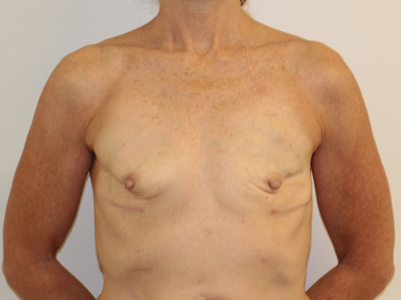Breast Reconstruction Beverly Hills