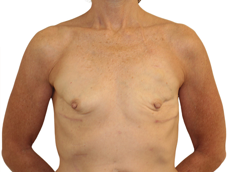 Breast Reconstruction Before and After | PERK Plastic Surgery