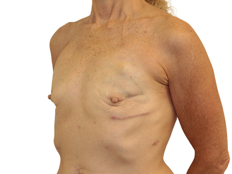 Breast Reconstruction Before and After | PERK Plastic Surgery