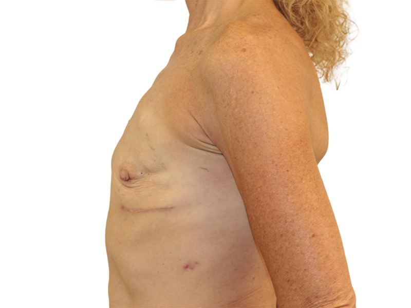 Breast Reconstruction Before and After | PERK Plastic Surgery
