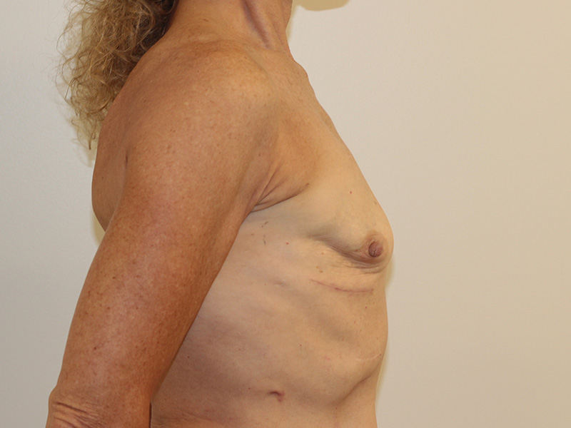 Breast Reconstruction Before and After | PERK Plastic Surgery