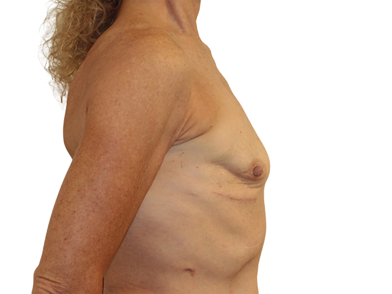 Breast Reconstruction Before and After | PERK Plastic Surgery