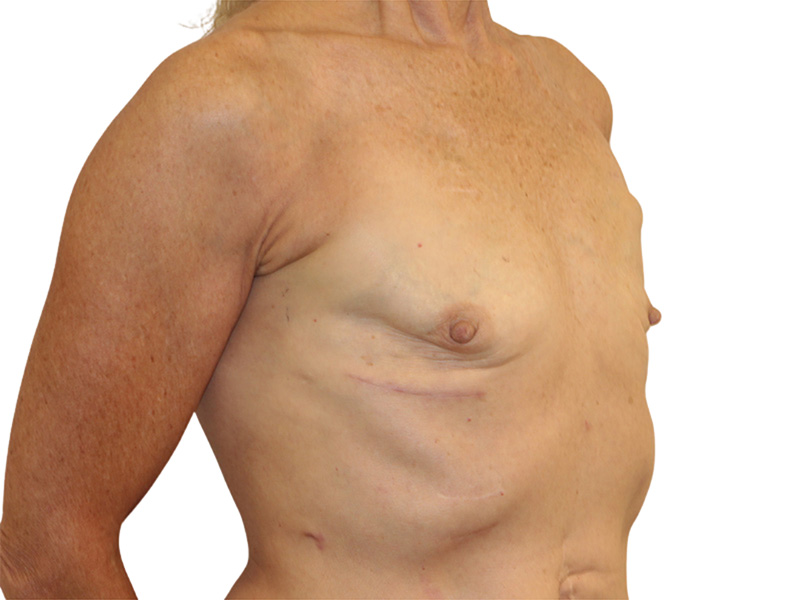 Breast Reconstruction Before and After | PERK Plastic Surgery
