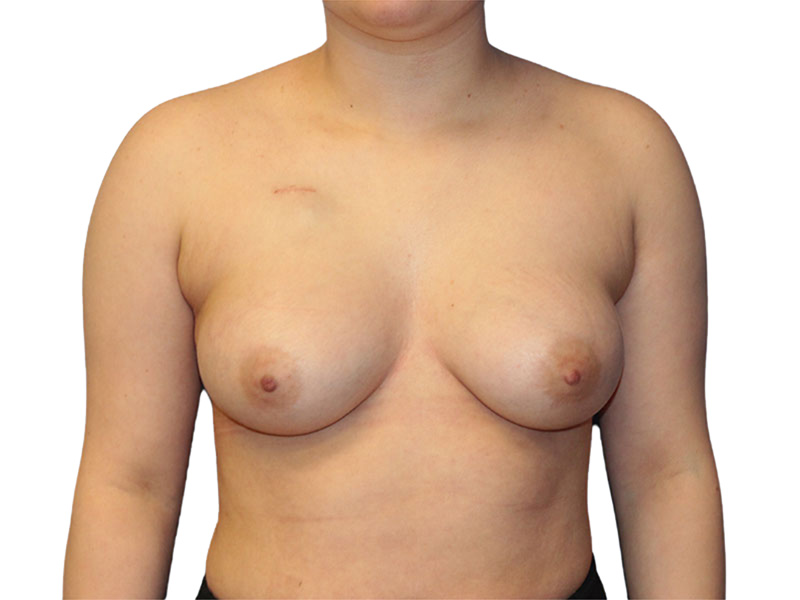 Breast Reconstruction Before and After | PERK Plastic Surgery