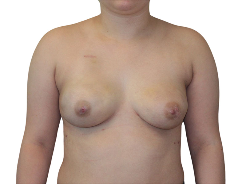 Breast Reconstruction Before and After | PERK Plastic Surgery