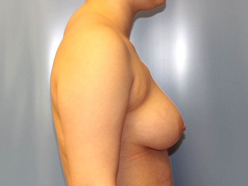 Breast Reconstruction Before and After | PERK Plastic Surgery