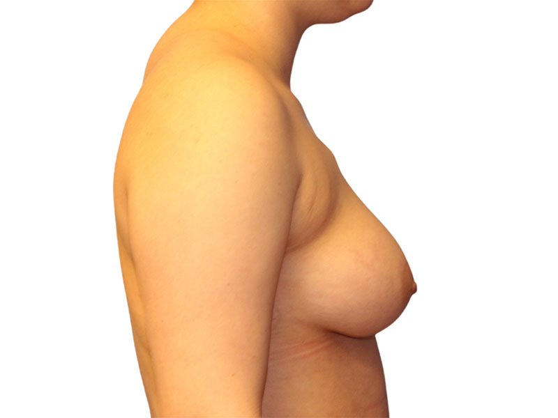 Breast Reconstruction Before and After | PERK Plastic Surgery