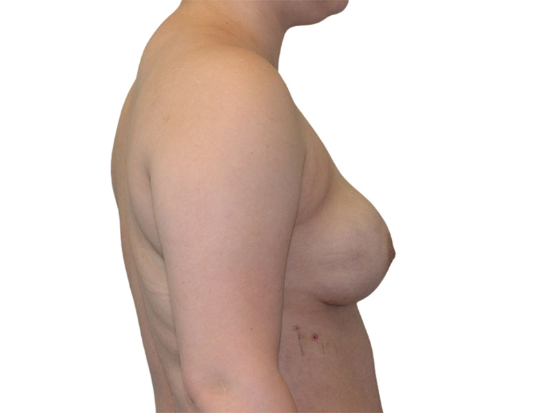 Breast Reconstruction Before and After | PERK Plastic Surgery