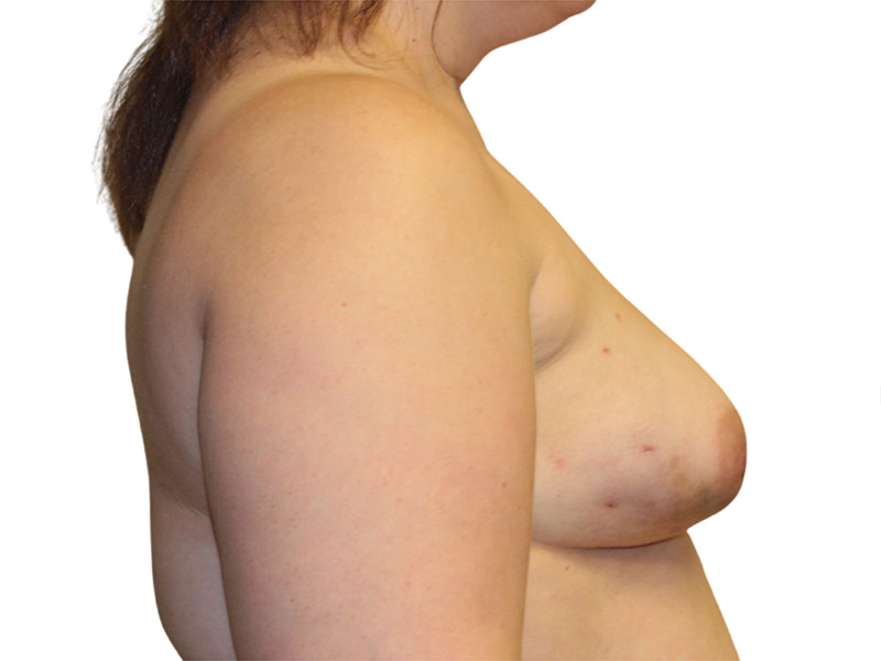 Breast Reconstruction Before and After | PERK Plastic Surgery