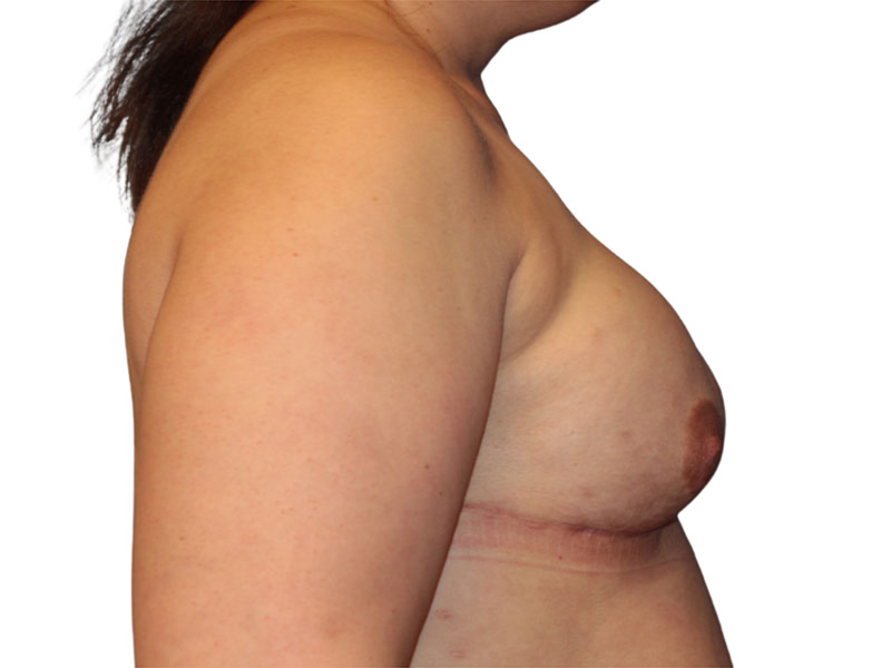 Breast Reconstruction Before and After | PERK Plastic Surgery