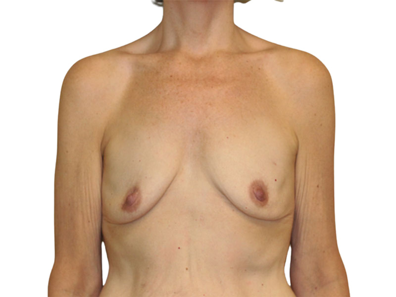 Breast Reconstruction Before and After | PERK Plastic Surgery