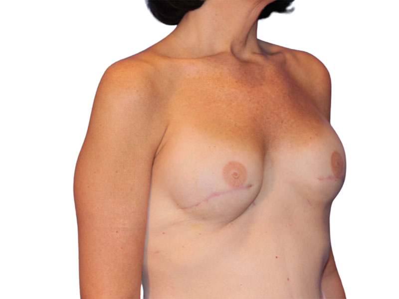 Breast Reconstruction Before and After | PERK Plastic Surgery