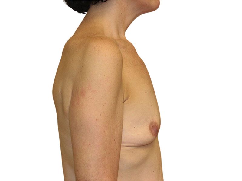 Breast Reconstruction Before and After | PERK Plastic Surgery
