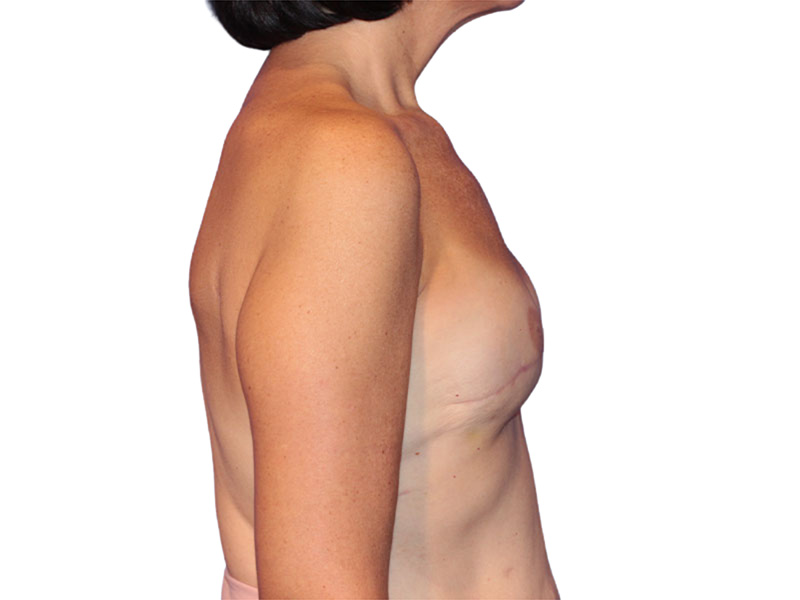 Breast Reconstruction Before and After | PERK Plastic Surgery