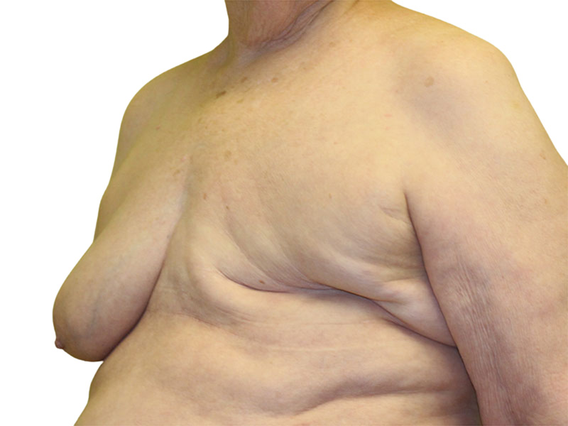Breast Reconstruction Before and After | PERK Plastic Surgery