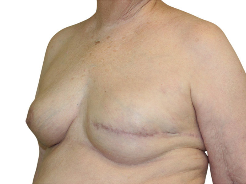 Breast Reconstruction Before and After | PERK Plastic Surgery