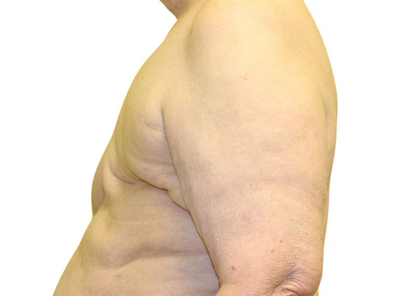Breast Reconstruction Before and After | PERK Plastic Surgery