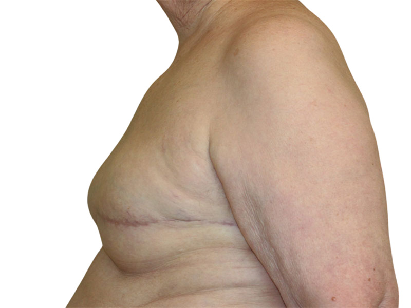 Breast Reconstruction Before and After | PERK Plastic Surgery