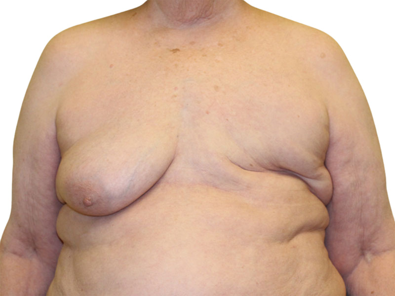 Breast Reconstruction Before and After | PERK Plastic Surgery