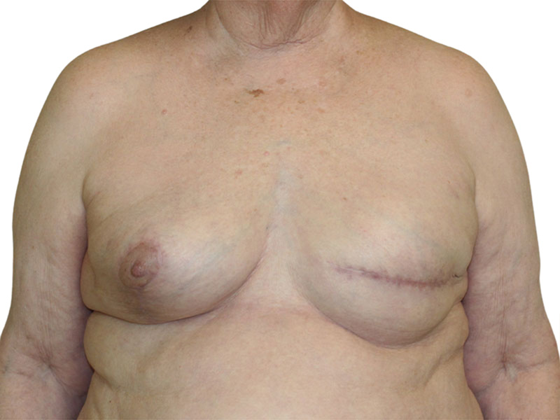 Breast Reconstruction Before and After | PERK Plastic Surgery