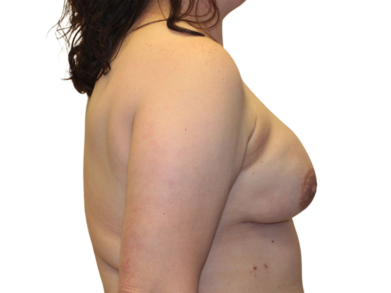 Breast Reconstruction Before and After | PERK Plastic Surgery