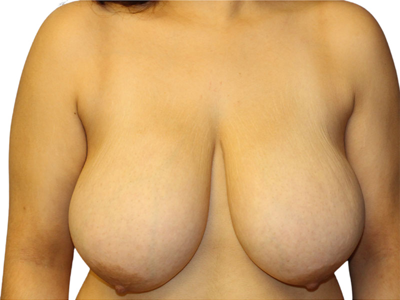 Breast Reduction Before and After | PERK Plastic Surgery