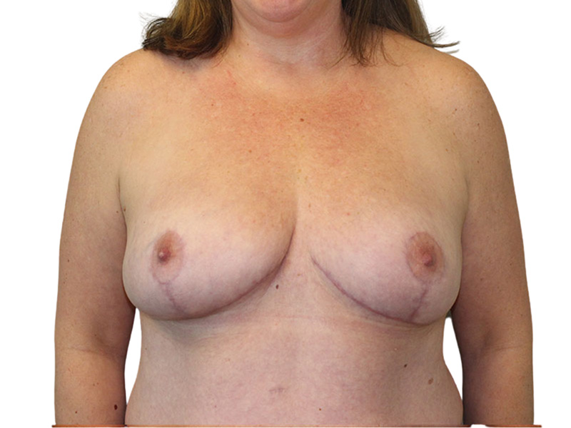 Breast Reduction Beverly Hills