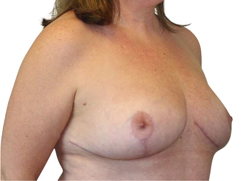 Breast Reduction Before and After | PERK Plastic Surgery