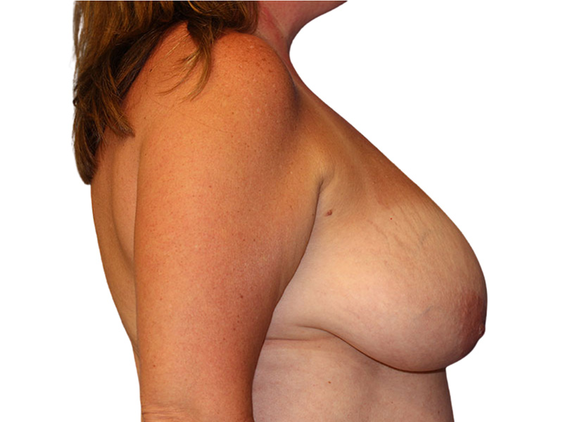 Breast Reduction Before and After | PERK Plastic Surgery