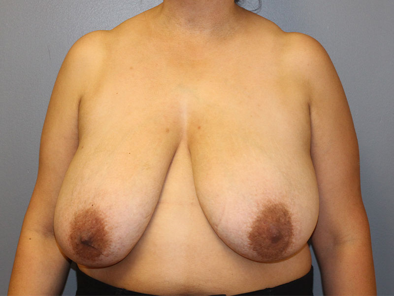 Breast Reduction Before and After | PERK Plastic Surgery