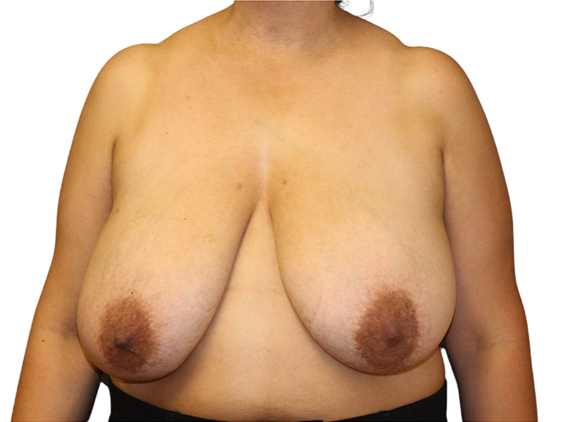 Breast Reduction Beverly Hills