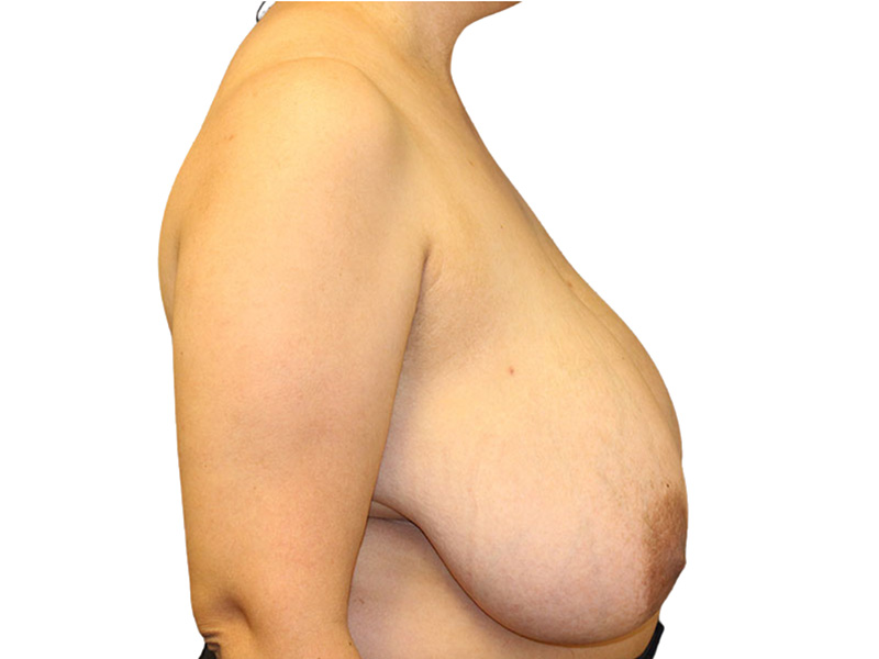 Breast Reduction Before and After | PERK Plastic Surgery